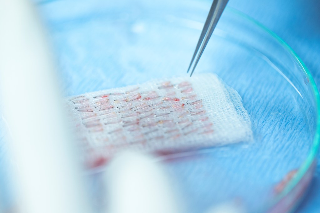 FUE. Plaukų folikulinio vieneto&nbsp;ištraukimas.