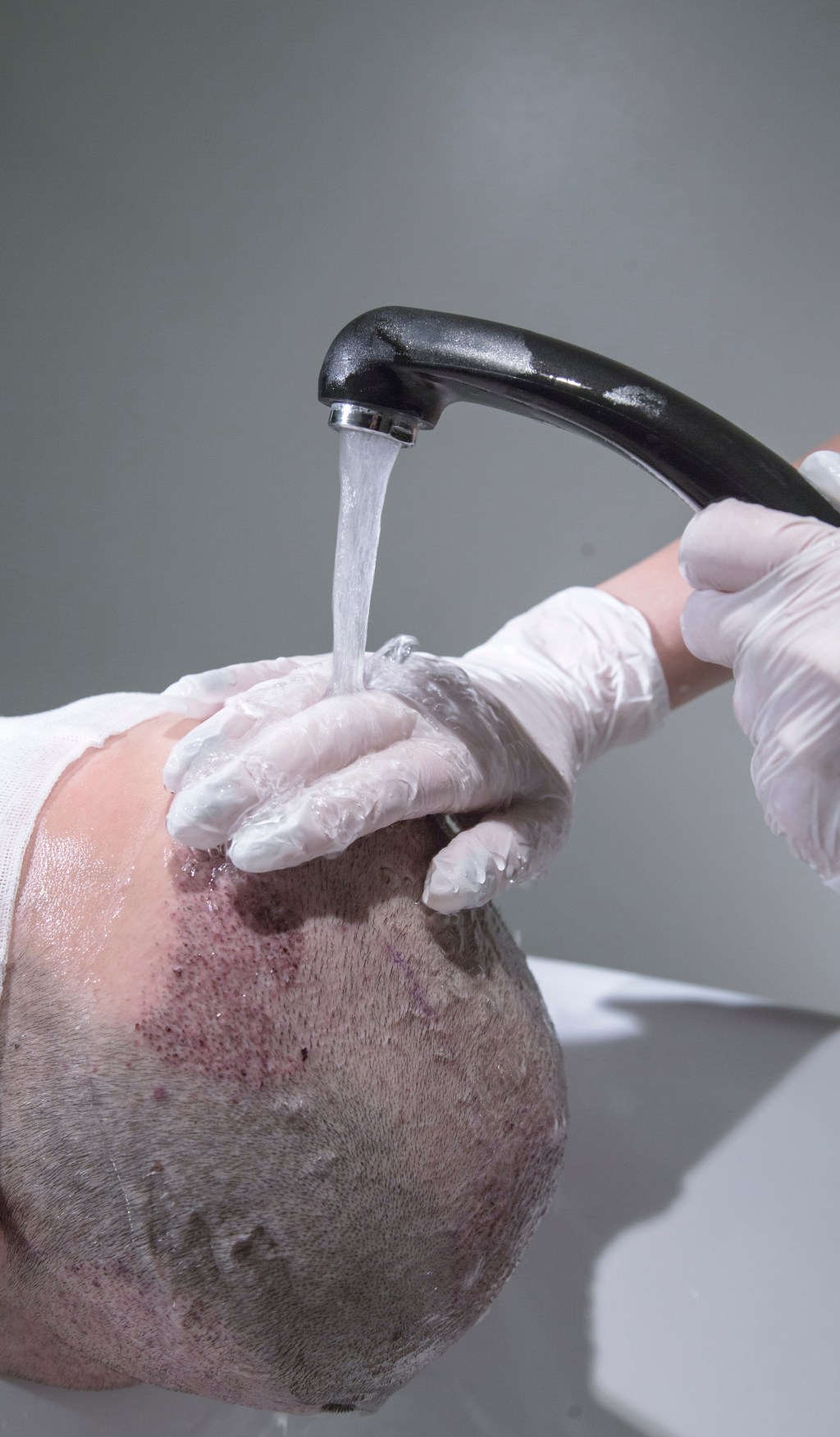 GALVOS PLOVIMAS PO PLAUKŲ TRANSPLANTACIJOS