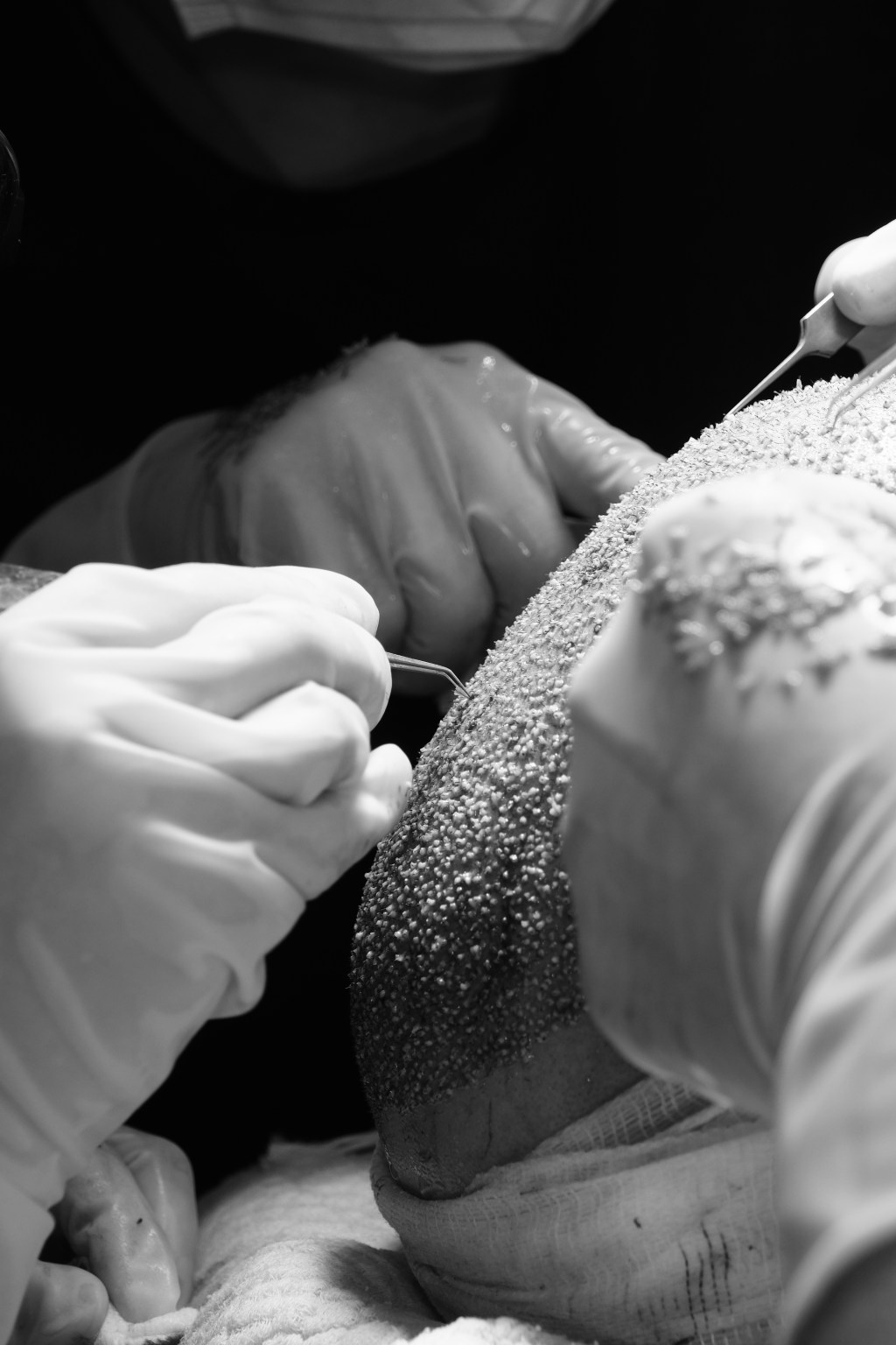 Plaukų persodinimas plaukuklinika.lt